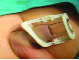 metode sunat smart klamp